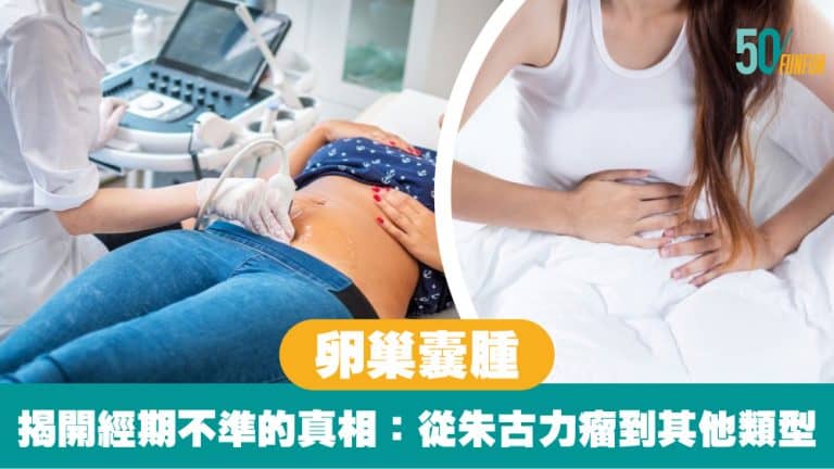 【卵巢囊腫】揭開經期不準的真相：從朱古力瘤到其他類型